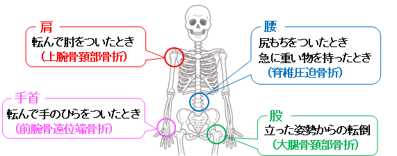 骨折しやすい部位のイラスト